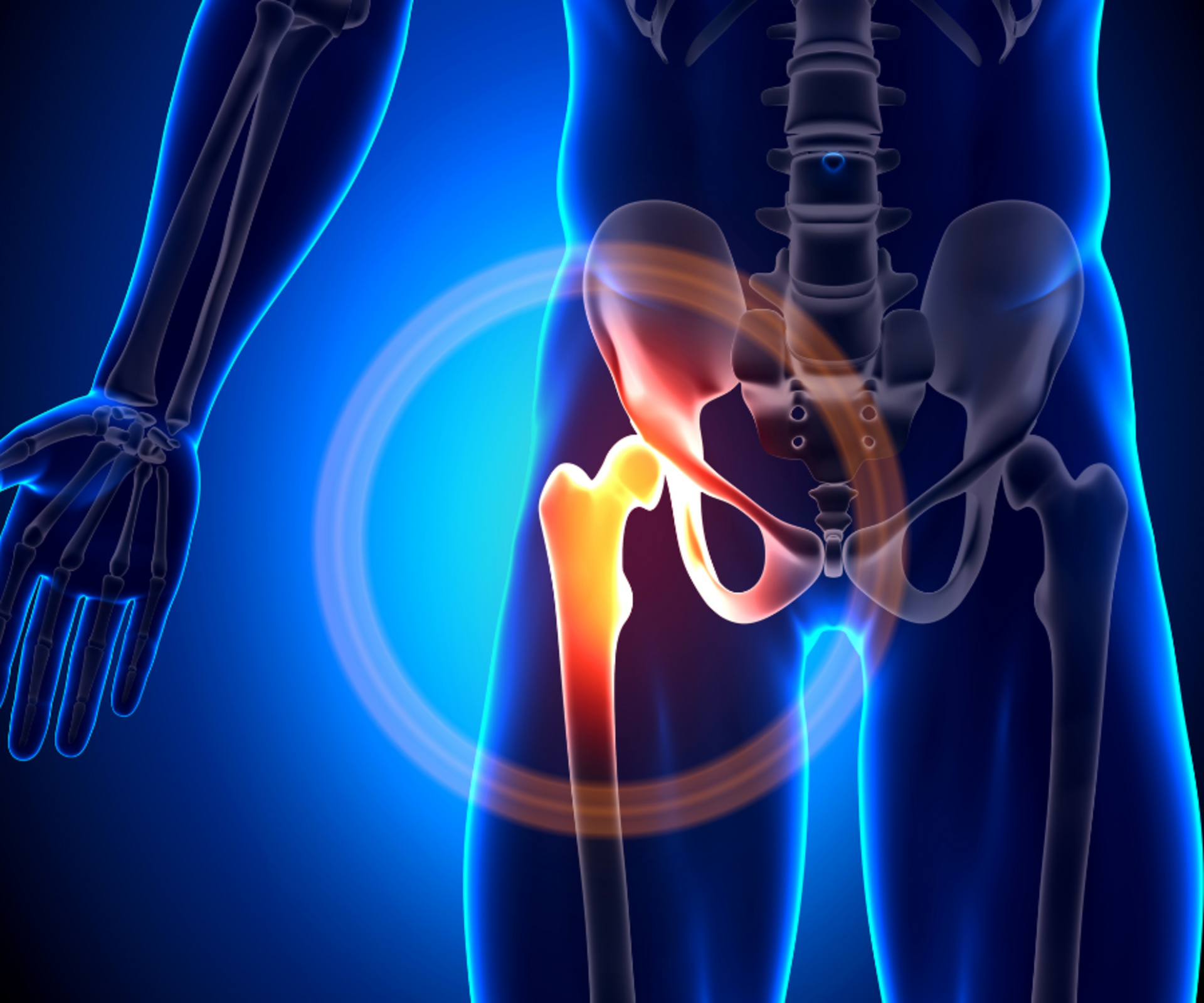 Total Hip Replacement (THR)